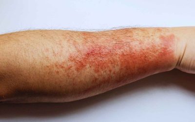 Dermatitis y pieles reactivas: devolviendo el confort a tu rostro