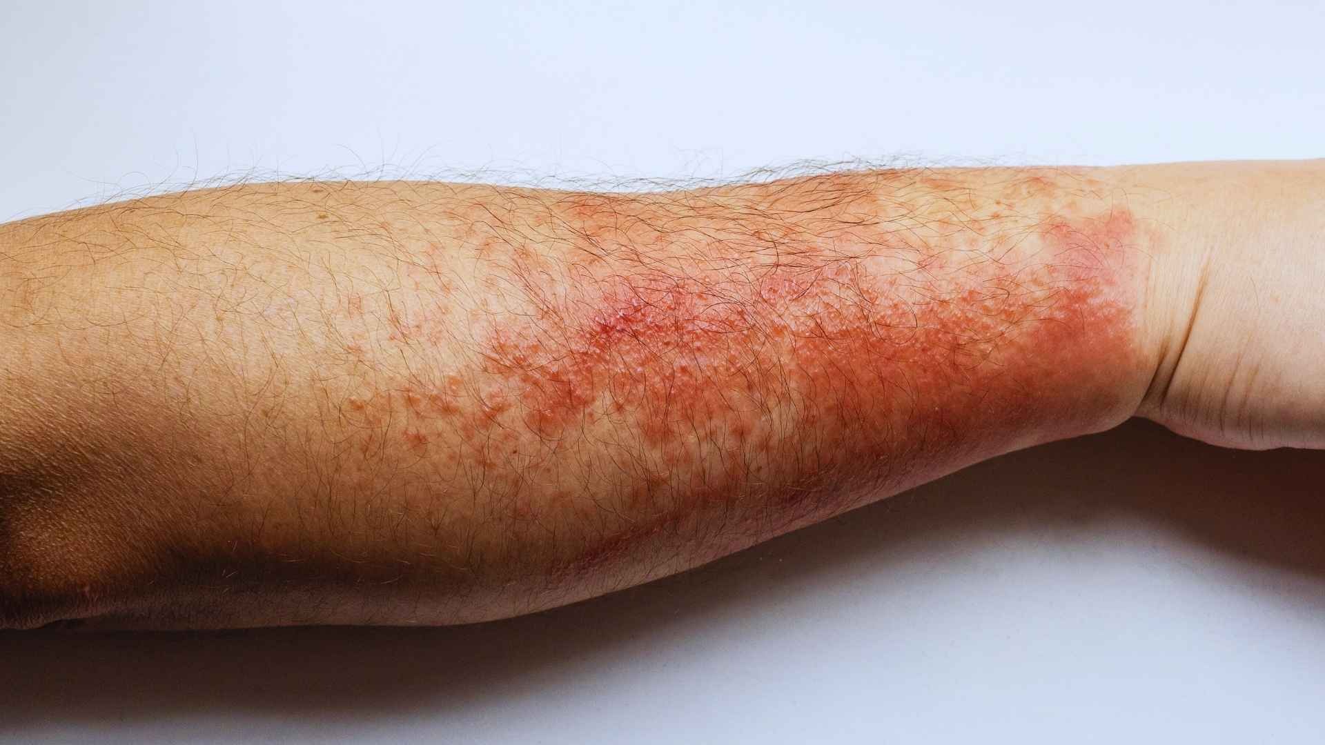 Dermatitis y pieles reactivas: devolviendo el confort a tu rostro - Dermayud