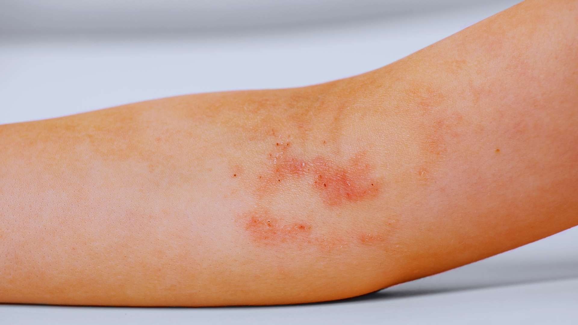 Dermatitis y pieles reactivas: devolviendo el confort a tu rostro - Dermayud
