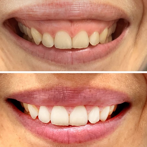 Sonrisa gingival